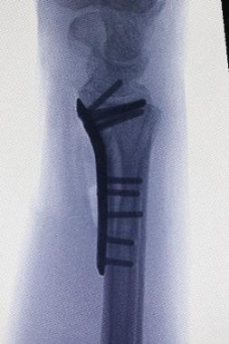 Distal radius kırığının titanyum kilitli plak ile fiksasyonu ve ulnar stiloid kırığının kancalı plak ile fiksasyonu