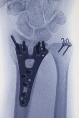 Distal radius kırığının titanyum kilitli plak ile fiksasyonu ve ulnar stiloid kırığının kancalı plak ile fiksasyonu