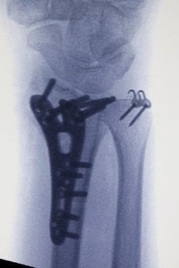 Distal radius kırığının titanyum kilitli plak ile fiksasyonu ve ulnar stiloid kırığının kancalı plak ile fiksasyonu