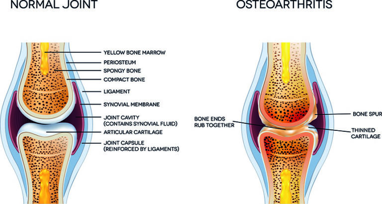  BAŞPARMAK OSTEOARTRİTİ