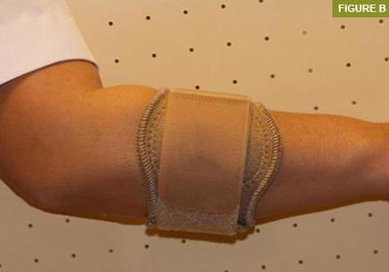 Tenişçi dirseği Lateral Epikondilit