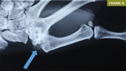 Başparmak Ağrıları