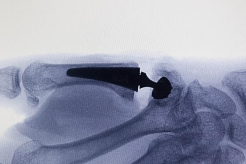 Başparmak Ağrıları