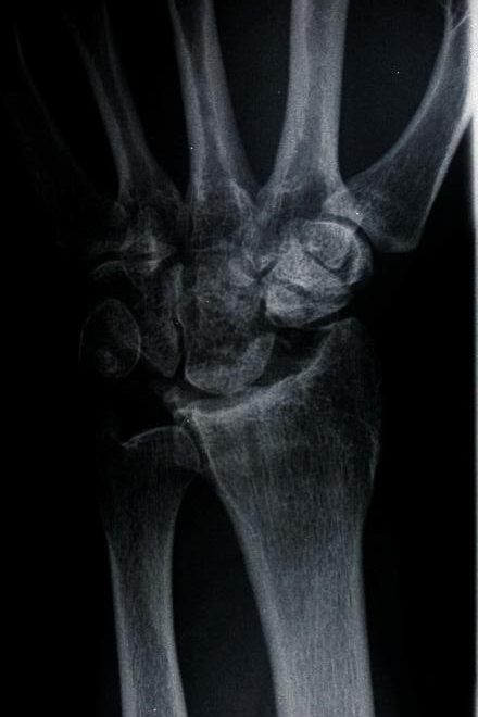 Burmec Bursa El Cerrahisi Microcerrahi BİLEK AĞRISI VE YARALANMALARI