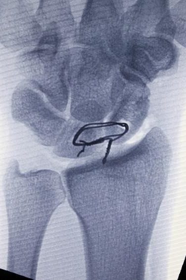 Burmec Bursa El Cerrahisi Microcerrahi BİLEK AĞRISI VE YARALANMALARI