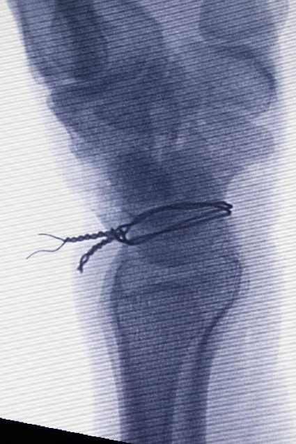 Burmec Bursa El Cerrahisi Microcerrahi BİLEK AĞRISI VE YARALANMALARI