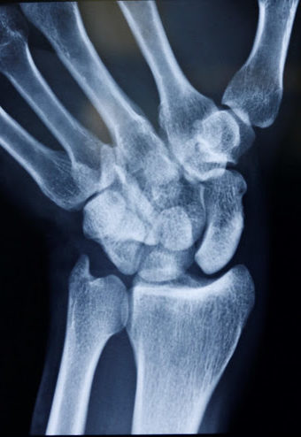 Burmec Bursa El Cerrahisi Microcerrahi BİLEK AĞRISI VE YARALANMALARI