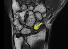 Burmec Bursa El Cerrahisi Microcerrahi BİLEK AĞRISI VE YARALANMALARI