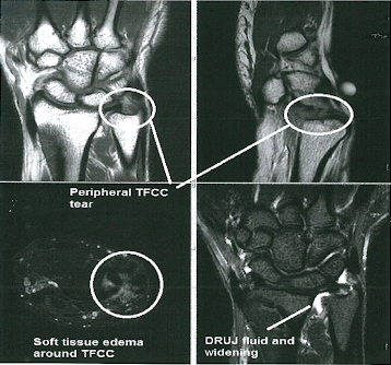 Burmec Bursa El Cerrahisi Microcerrahi BİLEK AĞRISI VE YARALANMALARI