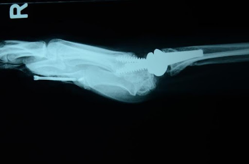 Burmec Bursa El Cerrahisi Microcerrahi BİLEK AĞRISI VE YARALANMALARI