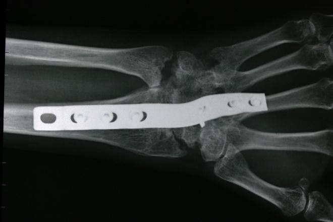 Burmec Bursa El Cerrahisi Microcerrahi BİLEK AĞRISI VE YARALANMALARI