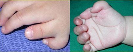 Doğumsal El Anomalileri