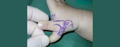 Doğumsal El Anomalileri