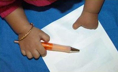 Doğumsal El Anomalileri