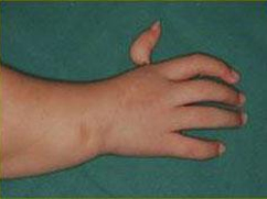 Doğumsal El Anomalileri