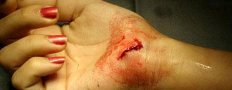 Burmec Bursa El Cerrahisi Microcerrahi El Yaralanmaları