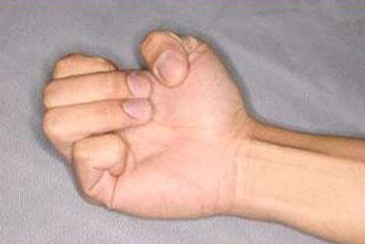 Burmec Bursa El Cerrahisi Microcerrahi El Yaralanmaları