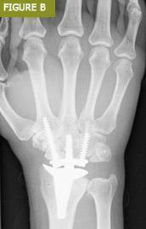 Bursa El Cerrahisi Parmak, El ve Bilekte Yapay Eklem Değiştirme, Bilek Protezi