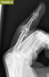 Bursa El Cerrahisi Parmak, El ve Bilekte Yapay Eklem Değiştirme, Bilek Protezi