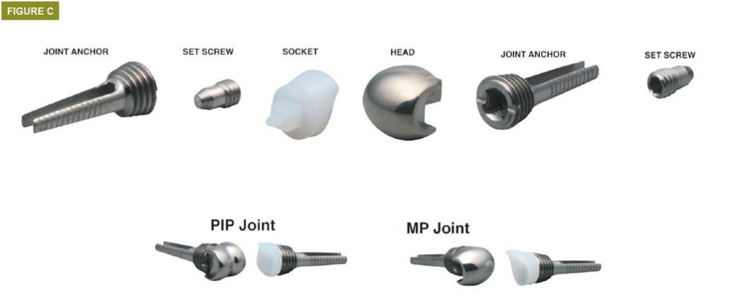 Bursa El Cerrahisi Parmak, El ve Bilekte Yapay Eklem Değiştirme, Bilek Protezi