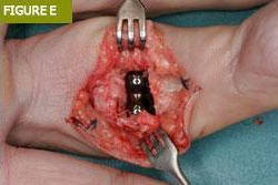 Bursa El Cerrahisi Parmak, El ve Bilekte Yapay Eklem Değiştirme, Bilek Protezi