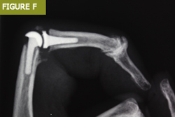 Bursa El Cerrahisi Parmak, El ve Bilekte Yapay Eklem Değiştirme, Bilek Protezi