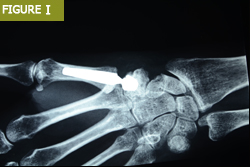 Bursa El Cerrahisi Parmak, El ve Bilekte Yapay Eklem Değiştirme, Bilek Protezi