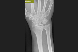 Bursa El Cerrahisi Parmak, El ve Bilekte Yapay Eklem Değiştirme, Bilek Protezi