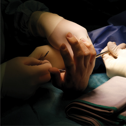 Burmec-Bursa-El-Cerrahisi-Mikro-Cerrahi