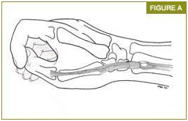 De Quervain Tenosinoviti, başparmak tendon sıkışması