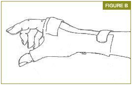 De Quervain Tenosinoviti, başparmak tendon sıkışması