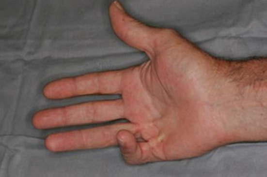 Dupuytren Kontraktürü