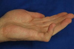 Dupuytren Kontraktürü