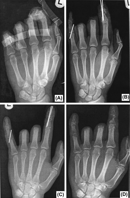 Ampütasyon Yaraları Burmec Bursa El Cerrahisi Microcerrahi