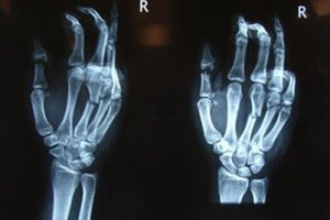 Kompleks El Yaralanmalarında Cerrahi Tedavi, TFCC YARALANMALARI Burmec Bursa El Cerrahisi Microcerrahi