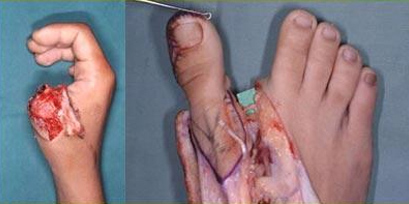 Rekonstrüktif Mikrocerrahi