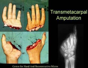 Parmak Replantasyonu (Parmak Kopması ve Dikilmesi)