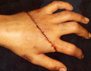 Parmak Replantasyonu (Parmak Kopması ve Dikilmesi)