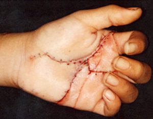 Parmak Replantasyonu (Parmak Kopması ve Dikilmesi)