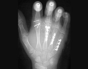 Parmak Replantasyonu (Parmak Kopması ve Dikilmesi)