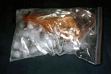 Parmak Replantasyonu (Parmak Kopması ve Dikilmesi)