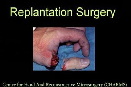 Parmak Replantasyonu (Parmak Kopması ve Dikilmesi)