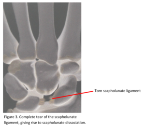 Skafolunat Bağ Yaralanması El Cerrahisi