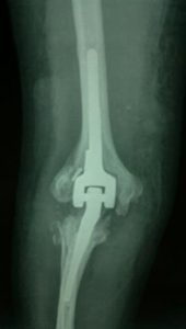 Üst Ekstremite Artriti Ekstremite Ağrısı