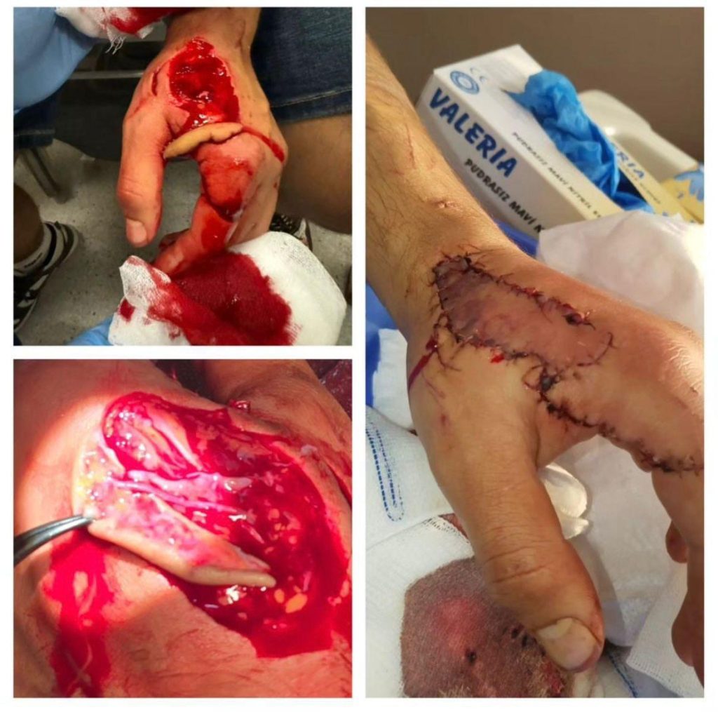 Bursa rekonstrüktif mikrocerrahi ve el cerrahisi merkezi