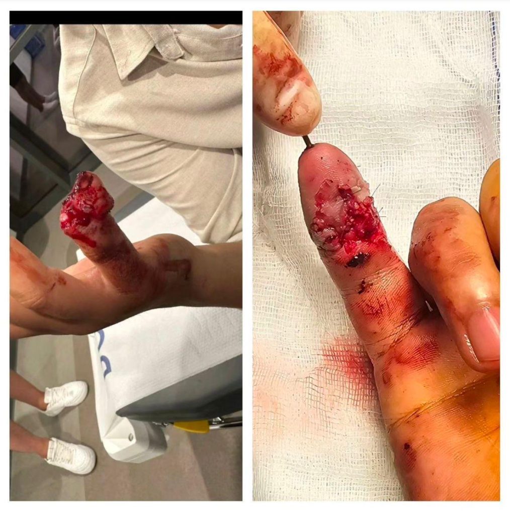 Parmak Replantasyonu Doktoru Nasıl Seçilir?