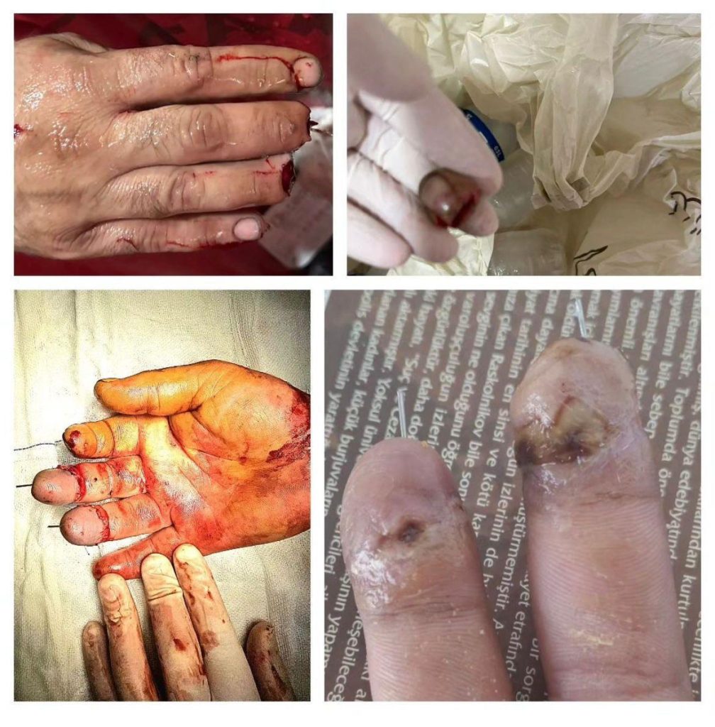 Parmak Replantasyonu Başarı Oranı Nedir?