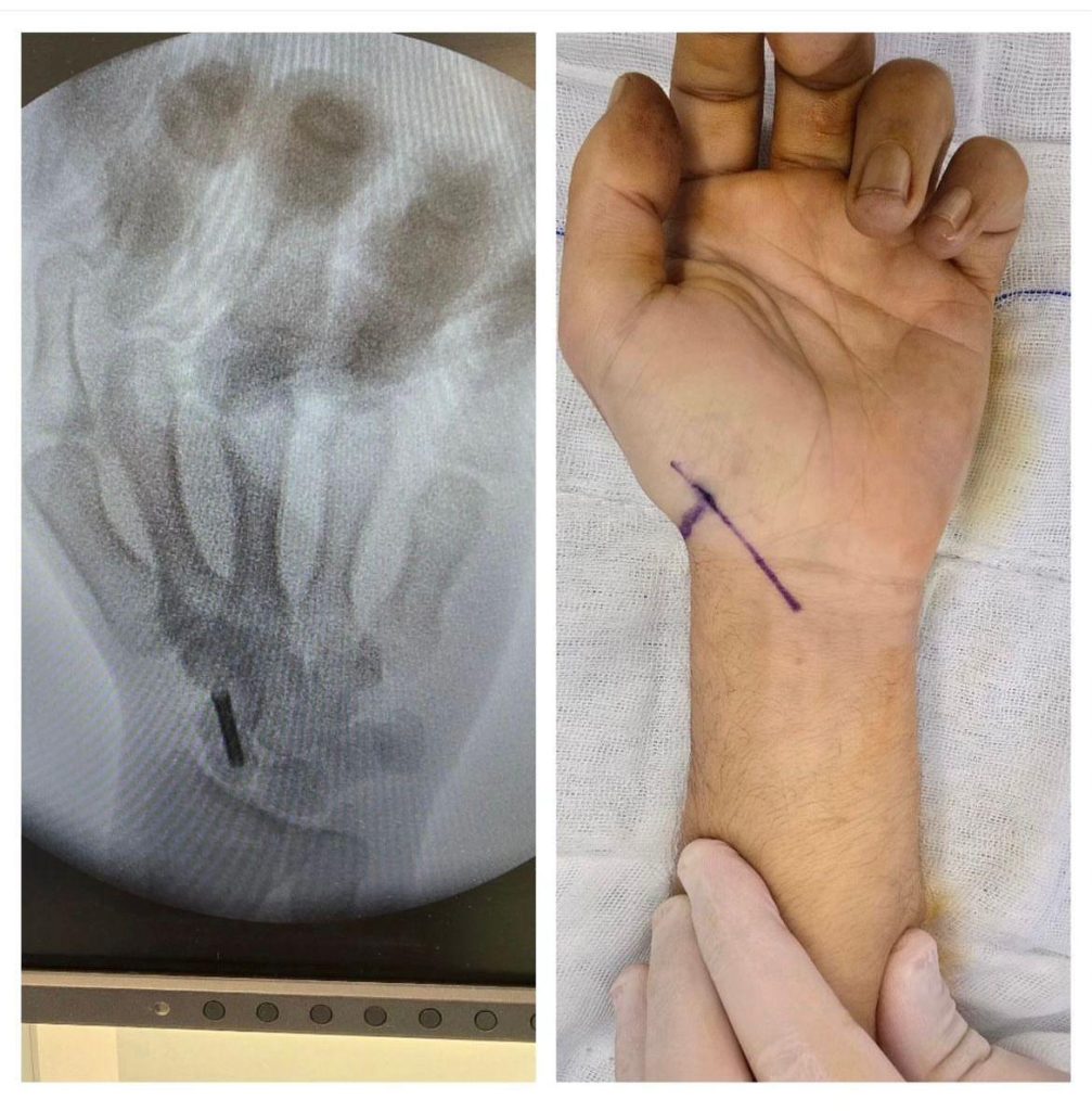 El Yaralanmalarının Nedenleri El yaralanmalarına yol açan en yaygın sebepler şunlardır: Kesici ve delici aletler: Bıçak, cam, makas gibi keskin nesnelerle temas sonucu oluşan yaralanmalar Ezilme ve çarpma: Ağır bir cismin el üzerine düşmesi veya sıkışma sonucu meydana gelen yaralanmalar Yanıklar: Sıcak cisimler, kimyasallar veya elektrikle temas sonrası oluşan hasarlar Kırıklar ve çıkıklar: Düşme, spor kazaları veya darbeler sonucu kemiklerde meydana gelen hasarlar Tendon ve sinir yaralanmaları: Kesikler veya travmalar sonucunda elin hareket kabiliyetini etkileyen yaralanmalar