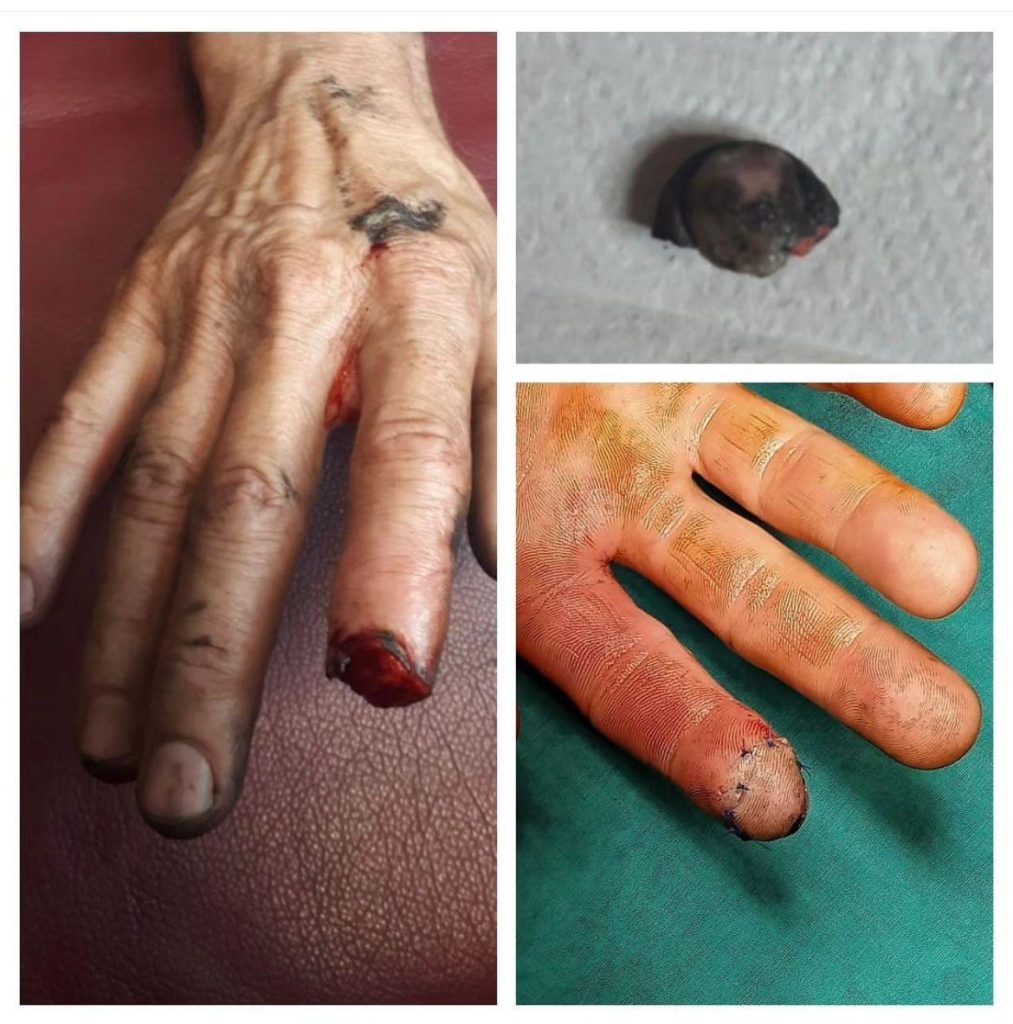 Parmak Replantasyonu Nedir?