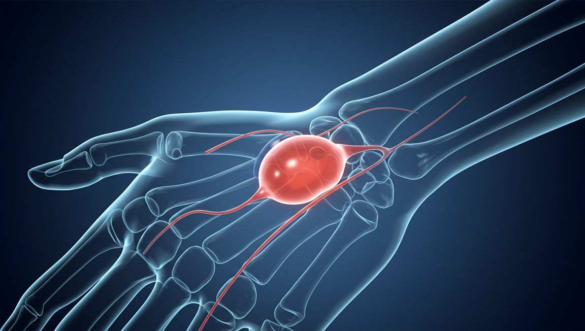 El Bileğinde Kitle veya Şişlik: Ganglion Kisti Belirtileri ve Tedavi Yöntemleri